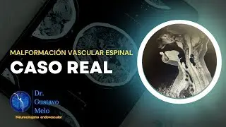 Todo sobre las Malformaciones Vasculares Espinales | CASO REAL