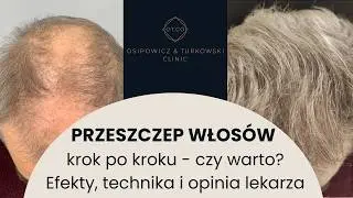 Przeszczep Włosów - Cała Prawda, czy Boli, jakie daje Efekty - Dr Piotr Turkowski