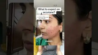 What to expect while on accutane 👀 #acne #accutane #skincare