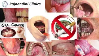 Oral cancer public awareness, Early detection can save life's.