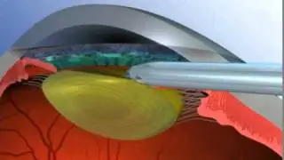 Cataract Surgery and the ReSTOR IOL
