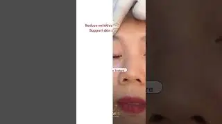 Recover Youthful Radiance with Gold Plated Microneedle RF at Glowwis Aesthetic! ✨