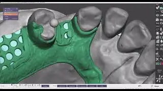exocad partial a p strap design2X