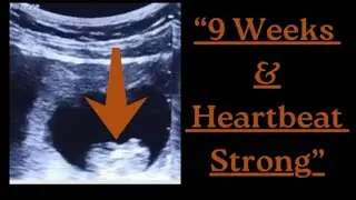 Threatened Abortion with Normal Heartbeat at 9 Weeks Explained