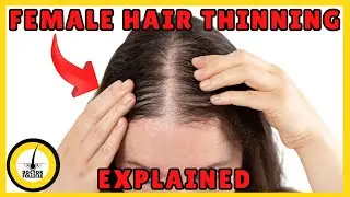Female Hair Thinning: Hormonal Causes & Evidence-Based Treatments