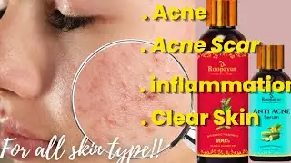 Does Great Skin Care Have To be Expensive??Review On Roopayur's Skin healing gel & Anti Acne Serum
