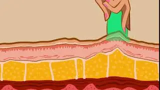 How Cellulite Massage Cups Work On The Dermis