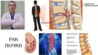 Ошибка лечения остеохондроза | СОВЕТЫ | Kidney Cancer and NSAID Drugs