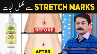 How to Remove Stretch Marks | Stretch Marks Removal Lotion | Dr Faisal Syed
