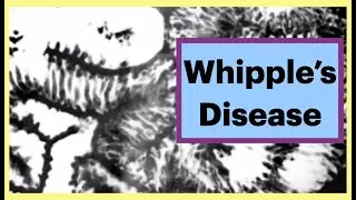 Whipple Disease #gastroenterology #radiology #learnwithme