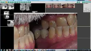 Multiple Posterior Implants  Treatment Planning and Case Presentation