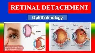 RETINAL DETACHMENT - Explained - Causes, Symptoms, Diagnosis& Treatment |for nursing, medical,