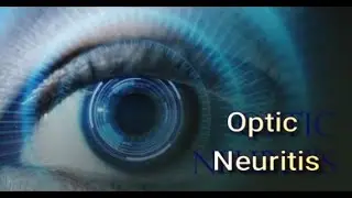 Optic Neuritis Alternative Treatment - Mind Over MS Podcast Episode 18