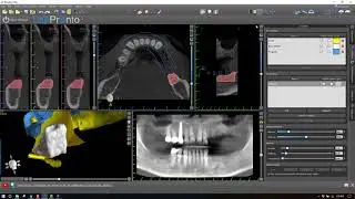 How to make a combination bone and tooth/tissue supported surgical guide