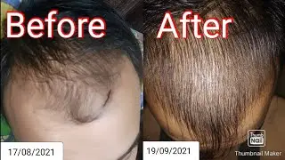 minoxidil 5 % and Derma roller results in 2 months