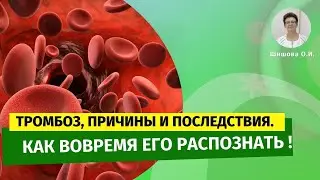 Тромбоз, причины и последствия. Как вовремя его распознать. [Шишова О.И.]