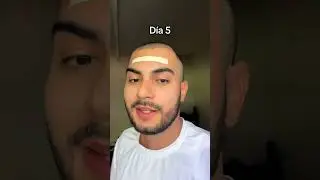 Proceso de 6 meses del trasplante capilar de Eduardo Fern&aacute;ndez 🤠💙 #injertocapilar