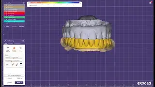 Pmma designing for lower fmr for single piece implant in Exocad