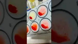 Blood grouping slide (ABO Rh typing)...#bloodtest #bloodgroup #labtechnician #shorts #shortvideo