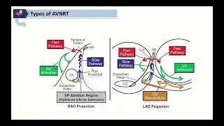 Jackman approach to AVNRT