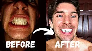 My Teeth Whitening Transformation | How I Keep My Teeth White
