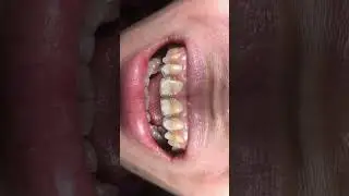 Smile Make Over with indirect Veneers&hellip; #dentist #smilemakeover #indirectveneers #dentistry