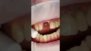Один новый зуб и снова красивая! Имплантация зубов.