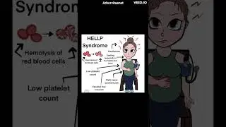 HELLP SYNDROME |ARBORVITAENXT| NEETPG INICET NEXTPG OBG