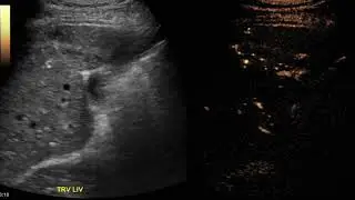 benign liver mass- OHSU Contrast Enhanced Ultrasound (CEUS)