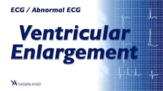 ECG 18 | Ventricular enlargement