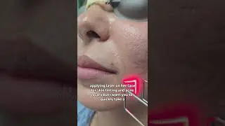 Co2 ablative laser.