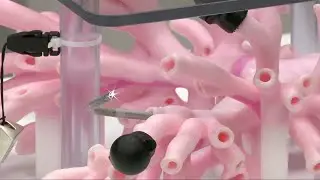 New lung cancer detection technology at Lima Memorial Health System