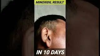 BEARD GROWTH | Minoxidil result in 10 days #Wantbeard #shorts