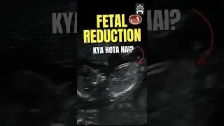 Fetal Reduction kya hota hai? | What is Fetal Reduction? | Dr. Nymphea Walecha #ivf #twinpregnancy