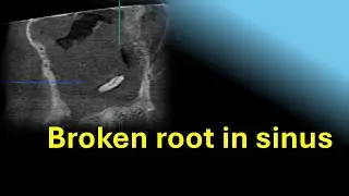 Visualizing Broken Root tip in Sinus with Dental Cone Beam