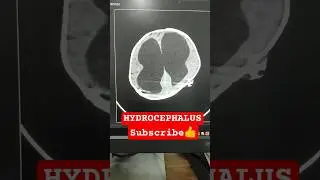 HYDROCEPHALUS #hydrocephalus #brain #pathology #ventricle #shorts #critical #radiology