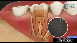 Post and core technique