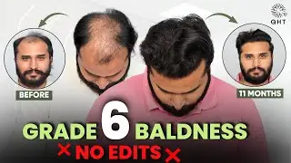 This is What Grade 6 Baldness: Now | Grade 6 Hairloss | Grade 6 Transplant | Grade 6 | QHT | 2026