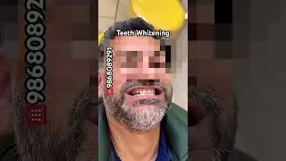 ‼️OFFER‼️TEETH Whitening 5999/- #braces #invisalign #smile #makeover #makeup #transition #tech #gym