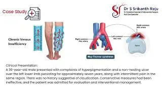 May-Thurner Syndrome |Non-Healing Leg Ulcer Treated with Vein Stenting & RFA