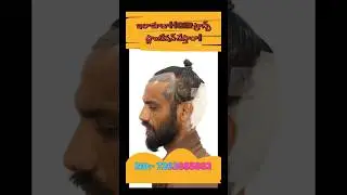 hair transplant Amazing result without save #haircut #haircare #hairstyle #viral #shortvideo #hair