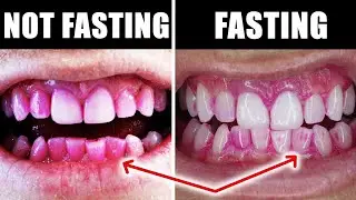 🦷 Dentist Explains How To Prevent Plaque & Cavities With Intermittent Fasting & The Stephan Curve!!