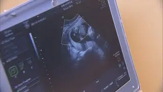 South Carolina abortion ban bill stalls in Senate subcommittee