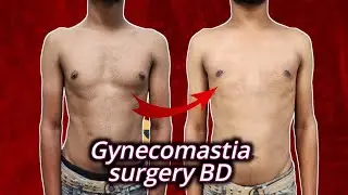 Gynecomastia nipple Reduction surgery with low cost 