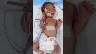 breathing problem child 😭 NICU #newborn baby & heartwarming 😞