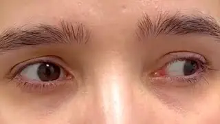 EYE Paralysis? - Internuclear ophthalmoplegia | Causes, Symptoms & Treatment