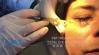 IFAAS Exclusive Technique: PRP Treatment for Total Eye Rejuvenation