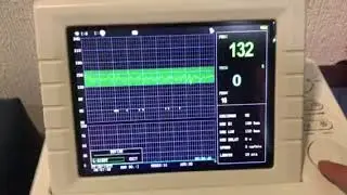 Monitorizaci&oacute;n cardiotocogr&aacute;fica