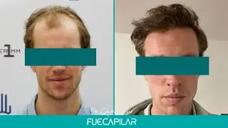 FUE Hair Transplant (3195 Grafts NW III) by Dr Gokhan Gür - FUECAPILAR, Istanbul, Turkey
