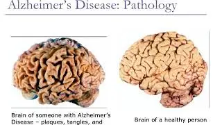 Alzheimer's Disease Audio